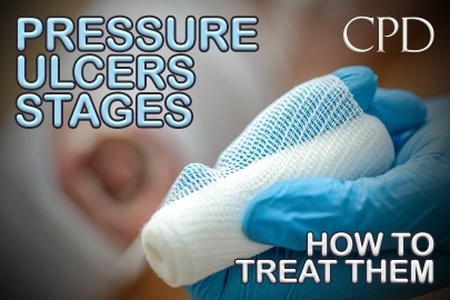 CPD – Pressure Ulcers Stages: How to Treat Them